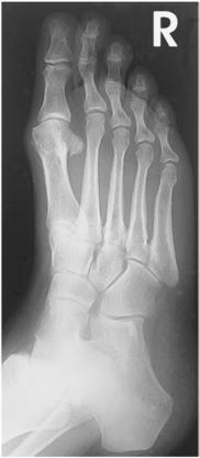 Fig. 6.60 AP oblic lateral la 30°