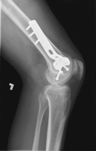 Fig. 7.40 Femurul mijlociu și distal în profil. (de la Fagan R, Furey AJ: