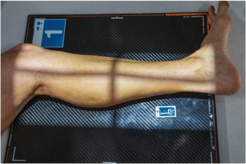 Fig. 6.101 Gambă mediolaterală — includerea ambelor articulații.