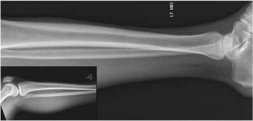 Fig. 6.102 Incidență mediolaterală a gambei. Imaginea inserată prezintă gamba proximală.