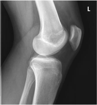 Fig. 6.113 Genunchi mediolateral. (Cu amabilitatea lui Joss Wertz, DO.)