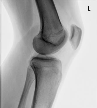 Fig. 6.114 Genunchi mediolateral. (Cu amabilitatea lui Joss Wertz, DO.)