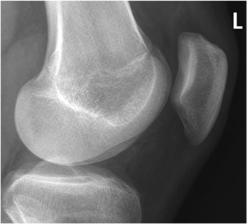 Fig. 6.133 Rotulă (patelă), profil. (Cu amabilitatea lui Joss Wertz, DO.)