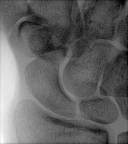 Fig. 4.104 Mâna ridicată, ulnar