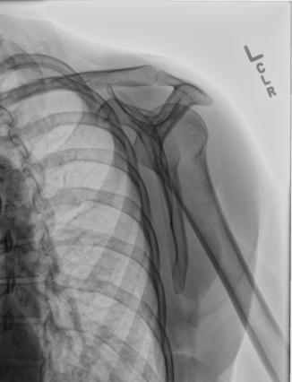 Fig. 5.105 Incidență laterală pentru acromion sau procesul coracoid (aproximativ