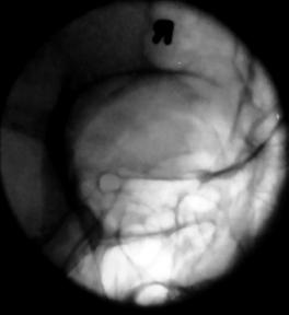 Fig. 11.154 bilateral parieto-