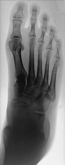 Fig. 6.57 AP picior.