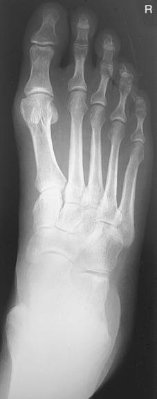 Fig. 6.58 AP picior.