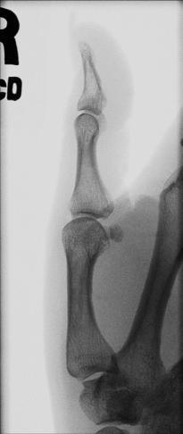 Fig. 4.58 Poziția părții—police în incidență laterală; raza centrală la prima articulație metacarpofalangiană (MCF).