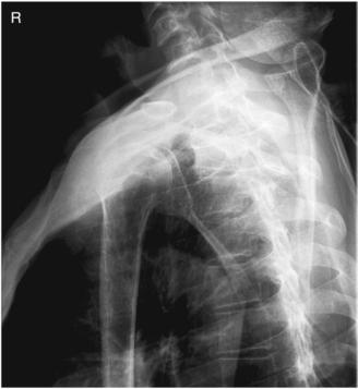 Fig. 5.75 Profil transthoracic în ortostatism.