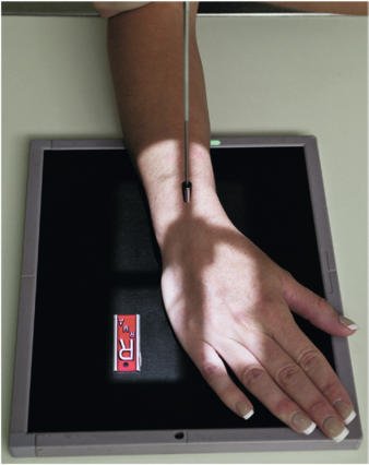 Fig. 4.108 PA pumn (articulație radiocarpiană)—deviație radială.
