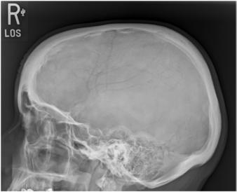 Fig. 11.111 profil.