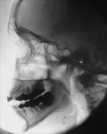 Fig. 11.127 profil masiv facial (oase ale feței).