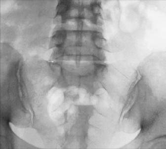 Fig. 9.43 AP axial L5–S1—35° cranial.