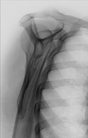 Fig. 5.78 Incidență PA oblică (profil lateral în Y scapular).