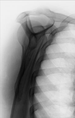 Fig. 5.79 Incidență PA oblică (profil lateral în Y scapular)