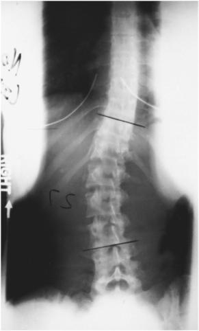 Fig. 9.53 PA cu bloc sub picior pe partea convexă a curbei.