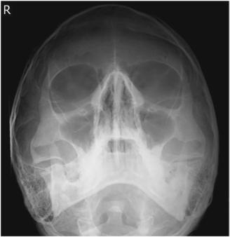 Fig. 11.193 Incidență parietoacantială—sinusuri. (După Curtis T: