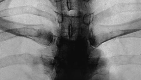 Fig. 10.29 Articulații sternoclaviculare, PA bilateral.