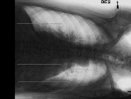 Fig. 2.69 Decubit lateral stâng.