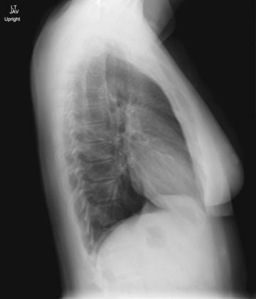 Fig. 2.59 Torace de profil stâng.