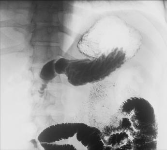 Fig. 12.95 Poziție RAO pentru tractul gastrointestinal superior.