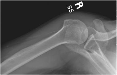 Fig. 5.47 Poziție alternativă — rotație exagerată.