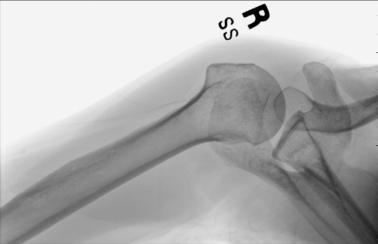 Fig. 5.48 Incidență axială inferosuperioară.