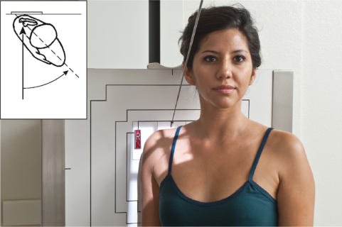 Fig. 5.85 Incidență apicală oblică axială în ortostatism — 45° oblic posterior,