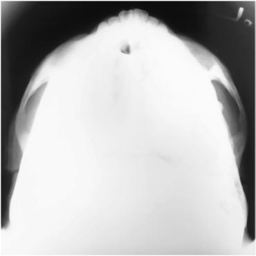 Fig. 11.145 Incidență SMV.