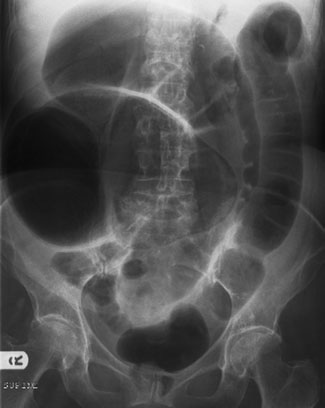 Radiografie de abdomen cu aparat mobil, în decubit dorsal, evidențiind ocluzie intestinală la nivelul intestinului subțire (nivele hidroaerice centrale).