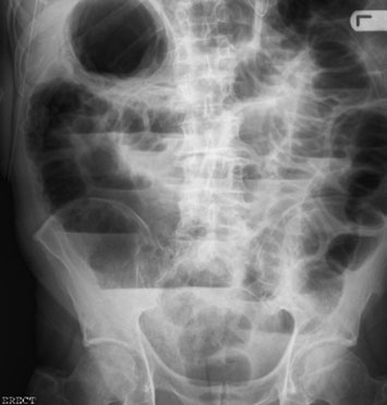 Imagine a abdomenului în incidență antero-posterioară (AP), în decubit lateral stâng, evidențiind