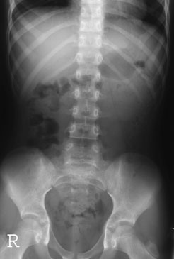 este puțin probabil ca anomalia radiografică să fie evidențiată în
