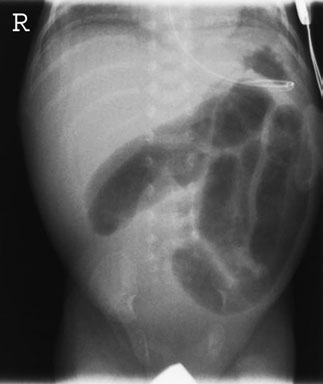 • Optimizarea radiografiilor abdominale include utilizarea unei tehnici cu doză mai mică, de exemplu fără