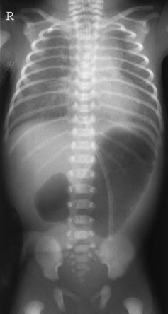 • radiografiile tractului renal pot fi colimate mai mult