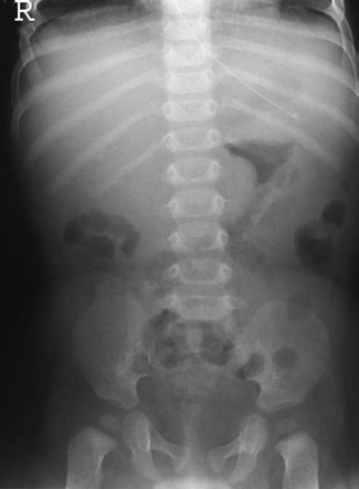 • Ecografia abdominală a înlocuit radiografia în multe