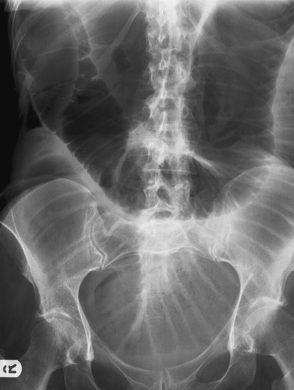 Radiografie anteroposterioară (AP) a abdomenului în decubit dorsal care evidențiază ileonul distal