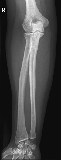 Radiografie normală anteroposterioară (AP) a antebrațului (radius și ulna)