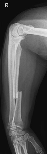 ulna, în timp ce în fractura Monteggia există o fractură a ulnei