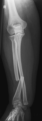 Radiografie normală de bază, de profil, a antebrațului (radius și ulna)