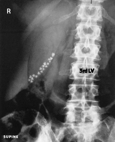 Imagine antero-posterioară (AP) în decubit dorsal a etajului abdominal superior, care evidențiază aer în