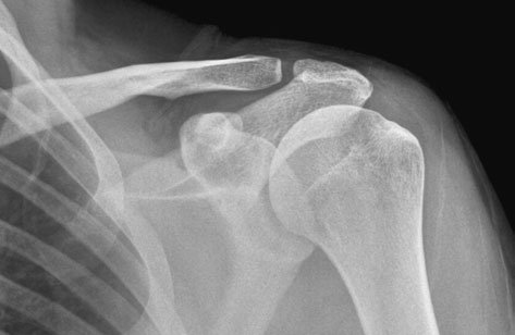 • Articulația normală are o lățime variabilă (3–8 mm). Normal