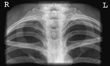 Radiografie normală a articulațiilor sternoclaviculare în incidență postero-anterioară (PA)