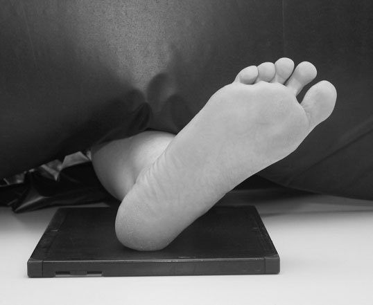 radiografie care evidențiază efectul angulației de 20°