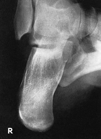 radiografie care evidențiază efectul angulației de 10°