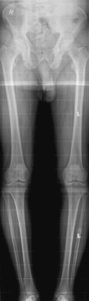 Evaluarea prin radiografie convențională film/ecran este sub-