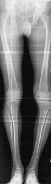 Radiografie digitală computerizată
