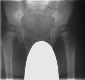• Radiografiile de șold reprezintă o solicitare frecventă la copii, dar examinarea inițială