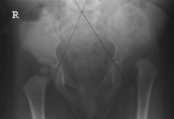Utilizarea acestei linii în radiografia AP directă a