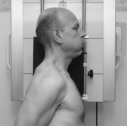Radiografie de profil care evidențiază laringele normal, umplut cu aer.
